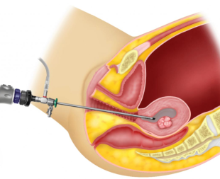 Pólipos Endometriais