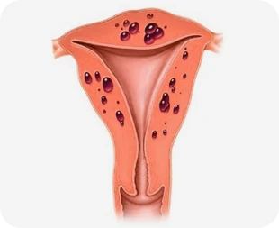Adenomiose